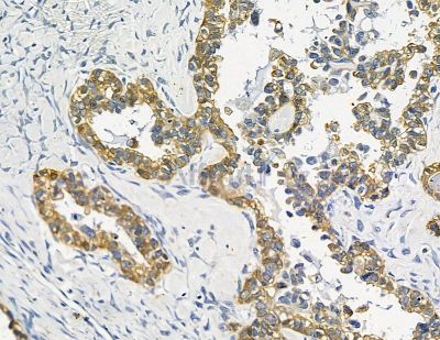 FNBP1L Antibody - DF15700 at 1/100 staining human ovarian cancer by IHC-P.