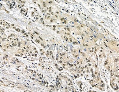 DTX3L Antibody - DF15713 at 1/100 staining human esophageal cancer and para-carcinoma tissue by IHC-P.