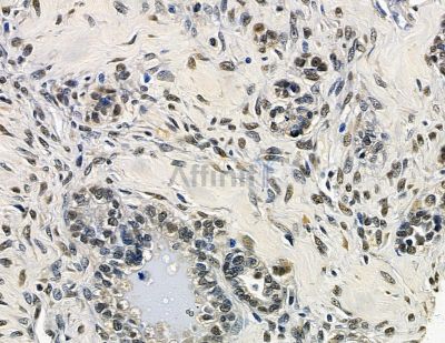 DTX3L Antibody - DF15713 at 1/100 staining human ovarian cancer by IHC-P.