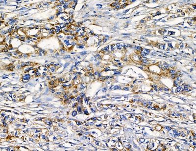 FNDC3A Antibody - DF15729 at 1/100 staining human pancreatic cancer and para-carcinoma tissue by IHC-P.