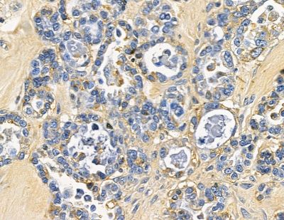 MARCH5 Antibody - DF15768 at 1/100 staining human ovarian cancer by IHC-P.