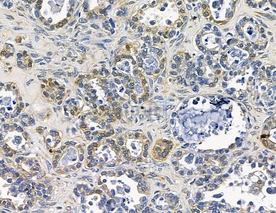 TOM1L1 Antibody - DF15773 at 1/100 staining human ovarian cancer by IHC-P.
