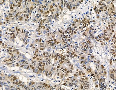 RFX2 Antibody - DF15783 at 1/100 staining human colorectal cancer by IHC-P.