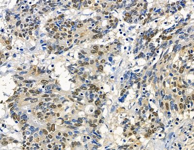RFX2 Antibody - DF15783 at 1/100 staining human prostate cancer by IHC-P.