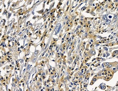 PAMR1 Antibody - DF15789 at 1/100 staining human pancreatic cancer and para-carcinoma tissue by IHC-P.
