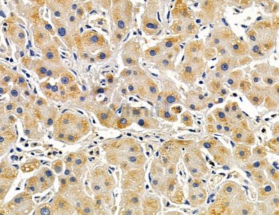 ENTPD7 Antibody - DF15822 at 1/100 staining human liver cancer by IHC-P.