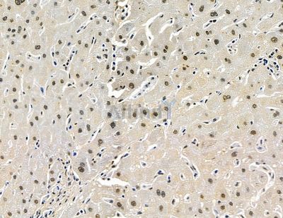 C2orf68 Antibody - DF15832 at 1/100 staining human prostate cancer and para-carcinoma tissue by IHC-P.