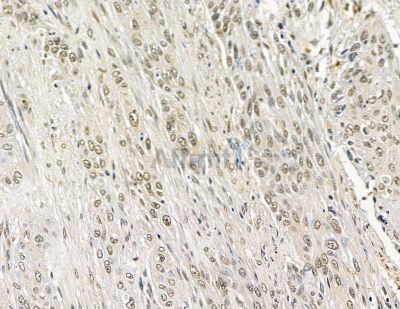 C2orf68 Antibody - DF15832 at 1/100 staining human esophageal cancer and para-carcinoma tissue by IHC-P.