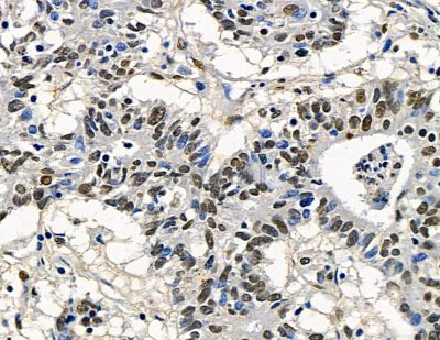 C2orf68 Antibody - DF15832 at 1/100 staining human colorectal cancer by IHC-P.