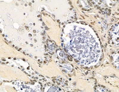 C2orf68 Antibody - DF15832 at 1/100 staining human ovarian cancer and para-carcinoma tissue by IHC-P.