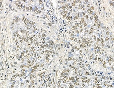 C2orf68 Antibody - DF15832 at 1/100 staining human lung cancer and para-carcinoma tissue by IHC-P.