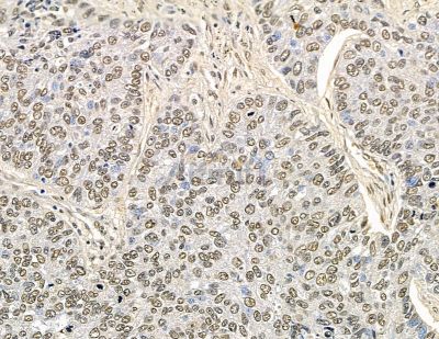 C2orf68 Antibody - DF15832 at 1/100 staining human liver cancer and para-carcinoma tissue by IHC-P.