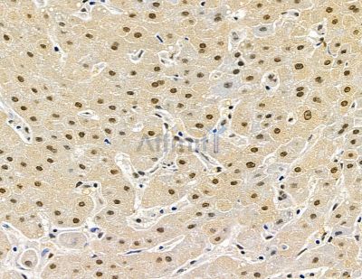 C2orf68 Antibody - DF15832 at 1/100 staining human liver cancer by IHC-P.