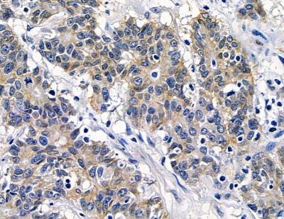 ZDHHC14 Antibody - DF15863 at 1/100 staining human colorectal cancer by IHC-P.