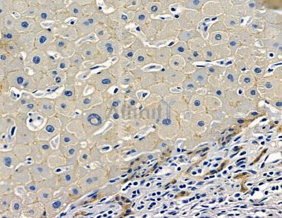 TM4SF4 Antibody - DF15884 at 1/100 staining human liver cancer by IHC-P.