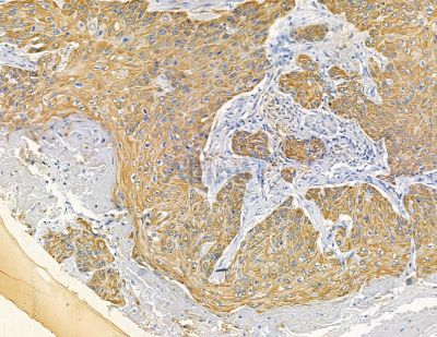 RNF186 Antibody - DF15951 at 1/100 staining human esophageal cancer by IHC-P.