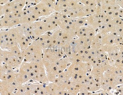 RFX1 Antibody - DF15965 at 1/100 staining human prostate cancer and para-carcinoma tissue by IHC-P.