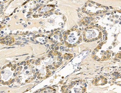 JOSD2 Antibody - DF15966 at 1/100 staining human ovarian cancer by IHC-P.