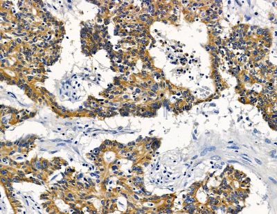 MPP7 Antibody - DF15967 at 1/100 staining human prostate cancer by IHC-P.