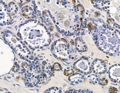 MPP7 Antibody - DF15967 at 1/100 staining human ovarian cancer by IHC-P.
