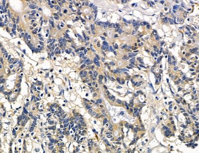 NHLRC2 Antibody - DF15989 at 1/100 staining human colorectal cancer and para-carcinoma tissue by IHC-P.