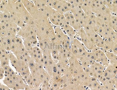 SKA2 Antibody - DF16014 at 1/100 staining human prostate cancer and para-carcinoma tissue by IHC-P.