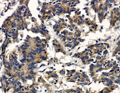 LRRC3B Antibody - DF16048 at 1/100 staining human colorectal cancer by IHC-P.