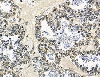LARP6 Antibody - DF16051 at 1/100 staining human ovarian cancer by IHC-P.