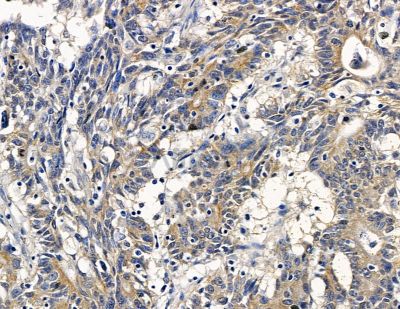 UTRN Antibody - DF16074 at 1/100 staining human colorectal cancer by IHC-P.