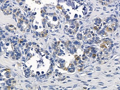IL-1R9 Antibody - AF9096 at 1/100 staining human colorectal cancer by IHC-P.