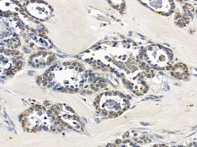 Nidogen Antibody - AF9131 at 1/100 staining human ovarian cancer by IHC-P.