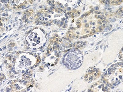 Nidogen Antibody - AF9131 at 1/100 staining human ovarian cancer by IHC-P.