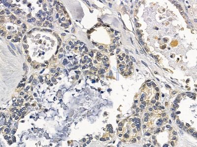 C16orf44 Antibody - DF10066 at 1/100 staining human ovarian cancer by IHC-P.