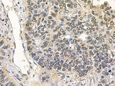 HMBOX1 Antibody - DF13062 at 1/100 staining human lung cancer and para-carcinoma tissue by IHC-P.