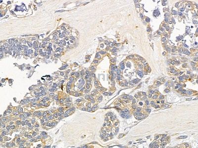 IFT122 Antibody - DF13082 at 1/100 staining human ovarian cancer by IHC-P.
