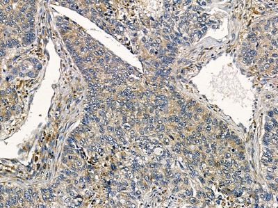 MFAP5 Antibody - DF13146 at 1/100 staining human lung cancer by IHC-P.