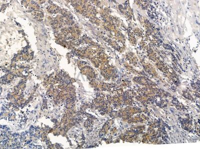 SIGLEC9 Antibody - DF13503 at 1/100 staining human colorectal cancer by IHC-P.