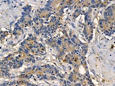 CLEC9A Antibody - DF14084 at 1/100 staining human colorectal cancer and para-carcinoma tissue by IHC-P.