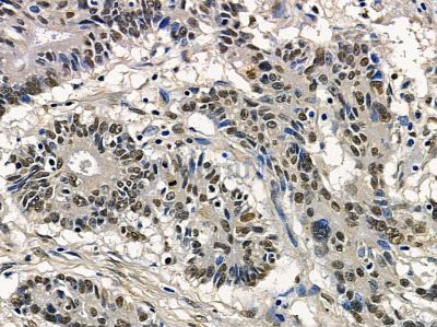 MOX1 Antibody - DF14205 at 1/100 staining human prostate cancer by IHC-P.
