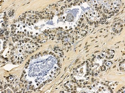 MOX1 Antibody - DF14205 at 1/100 staining human ovarian cancer by IHC-P.