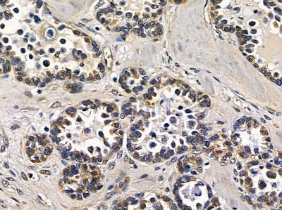 ASB4 Antibody - DF16107 at 1/100 staining human ovarian cancer by IHC-P.