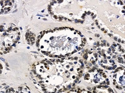 FAM122B Antibody - DF16121 at 1/100 staining human ovarian cancer by IHC-P.