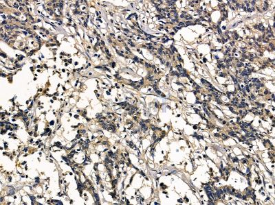 ARL14 Antibody - DF16123 at 1/100 staining human colorectal cancer and para-carcinoma tissue by IHC-P.