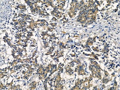 AKR1C2 Antibody - DF3757 at 1/100 staining human prostate cancer by IHC-P.