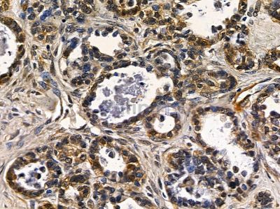 ALS2CR13 Antibody - DF3776 at 1/100 staining human ovarian cancer by IHC-P.