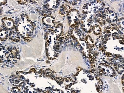 PLK5 Antibody - DF4472 at 1/100 staining human ovarian cancer by IHC-P.