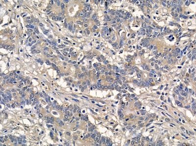 MEGF6 Antibody - DF9644 at 1/100 staining human prostate cancer by IHC-P.