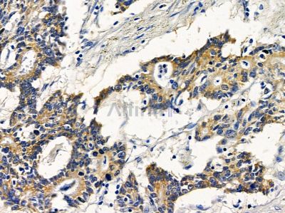ZIP2 Antibody - AF9234 at 1/100 staining human colorectal cancer by IHC-P.