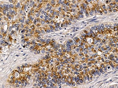 GRP78 Mouse monoclonal Antibody - BF8024 at 1/100 staining human lung cancer and para-carcinoma tissue by IHC-P.