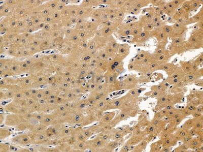 GSTO1 Antibody - DF12626 at 1/100 staining human prostate cancer and para-carcinoma tissue by IHC-P.